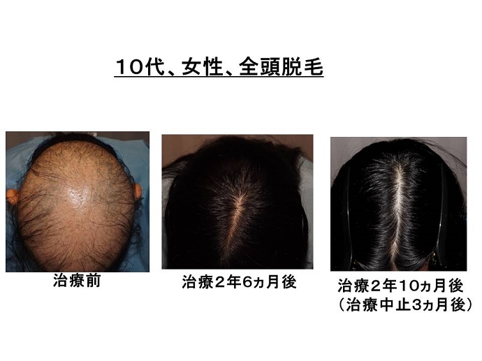 円形脱毛症　病院